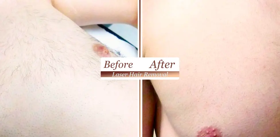 Before After Laser Hair Removal Purbeck Aesthetics (1)