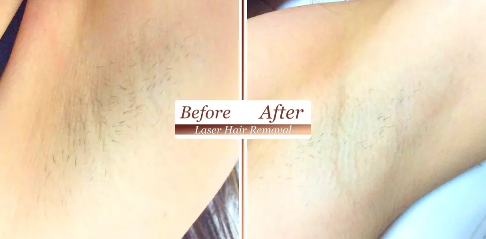 Before After Laser Hair Removal Wareham Purbeck Aesthetics (1)