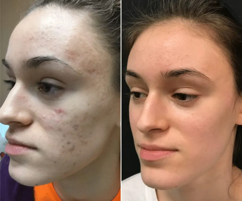 Plasma Skin Tightening?